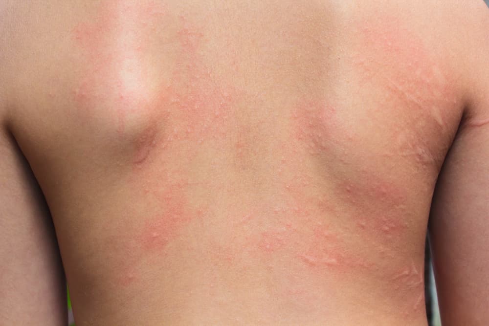 alergic rash cause by carpet beetles